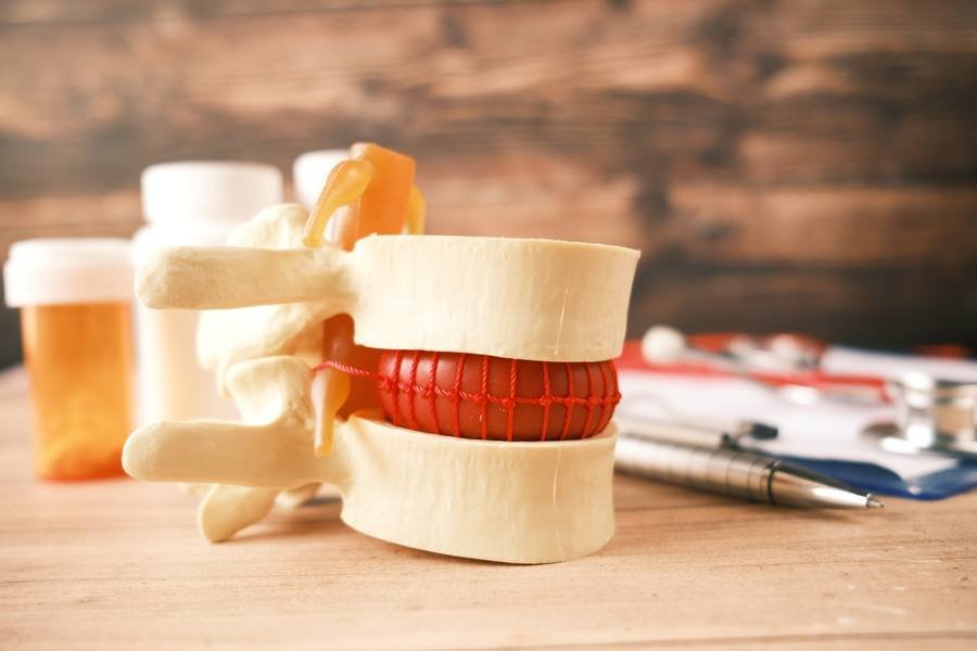 Spinal anatomy model showing lumbar disc and nerve root anatomy